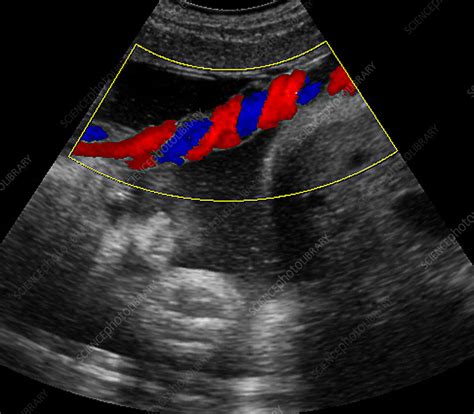 Umbilical cord blood flow, ultrasound - Stock Image P680/0755 - Science Photo Library