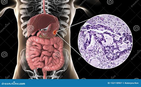 Stomach Adenocarcinoma, Gastric Cancer, Illustration And Light Micrograph | CartoonDealer.com ...