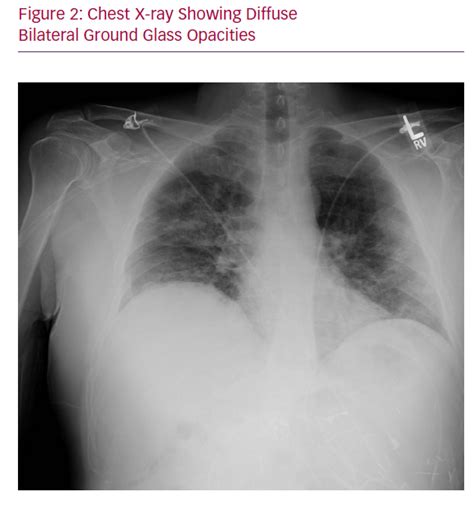 Chest X-ray Showing Diffuse Bilateral Ground Glass Opacities | Radcliffe Cardiology