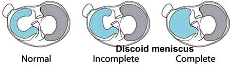 Discoid meniscus causes, symptoms, diagnosis, treatment & prognosis