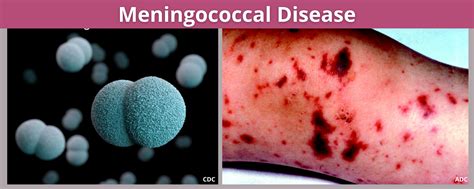 Meningococcal Disease - Benton Franklin Health District