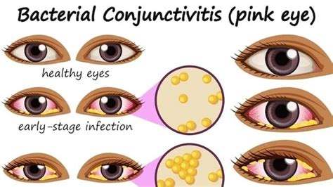 Conjunctivitis: Simple home remedies to treat the eye condition ...