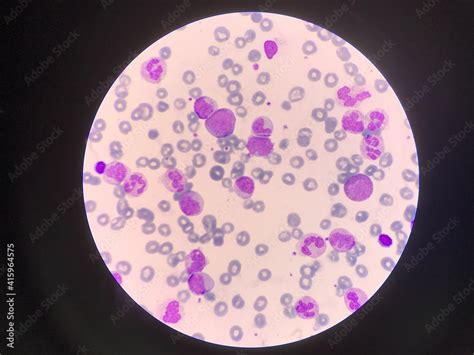 Immature and mature white blood cells.Segmented neutrophil,blast cells myelocyte,metamyelocyte ...