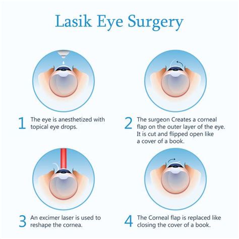 What Is LASIK And Refractive Surgery?