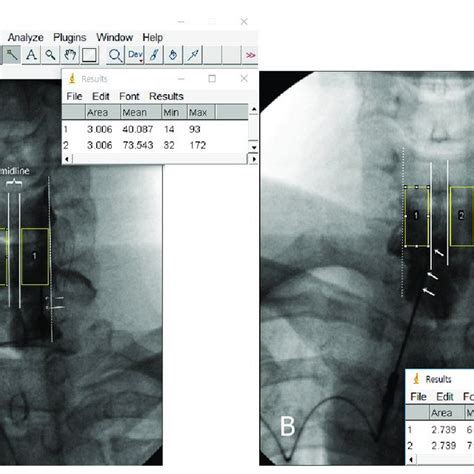 Confirmatory contrast medium spread of cervical interlaminar epidural... | Download Scientific ...