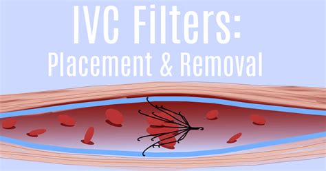 UVA Radiology- IVC Filters: Placement and Removal