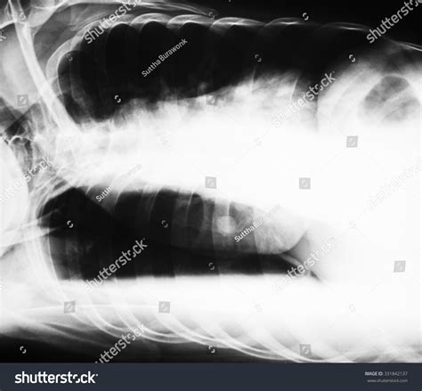 Chest Xray Image Right Lateral Decubitus ภาพสต็อก 331842137 | Shutterstock