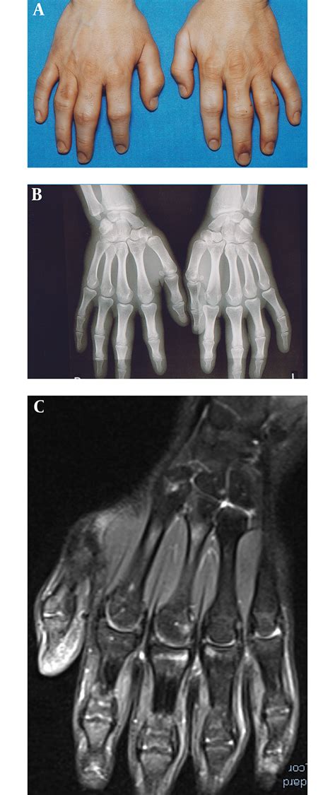 Enlargement of the proximal interphalangeal joints II-IV of both the... | Download Scientific ...