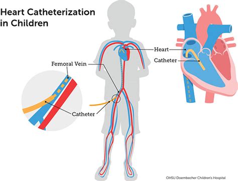 Right Heart Catheterization Normal Values