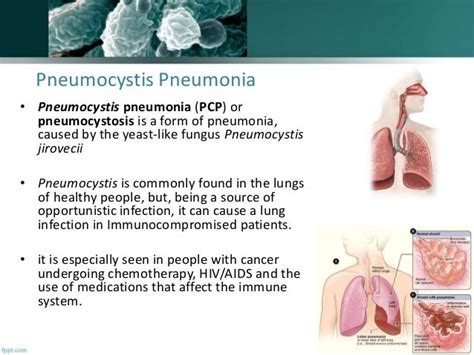 Pneumocystis Pneumonia