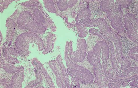 Inverted papilloma histopathology (H&E-10×) | Download Scientific Diagram