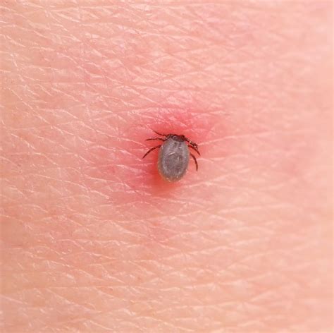 How to Treat a Tick Bite the Right Way, According to Dermatologists in ...