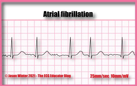 ECG Educator Blog : Atrial Fibrillation (AF)