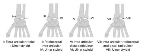 Fraturas do Rádio Distal | Concise Medical Knowledge