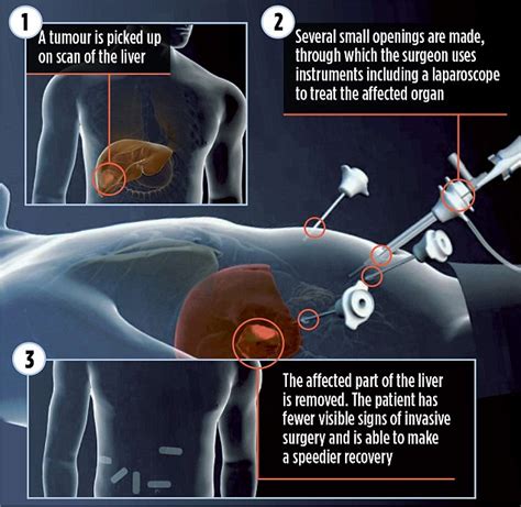 Doctors trial keyhole operation to fight colon cancer invading your liver | Daily Mail Online