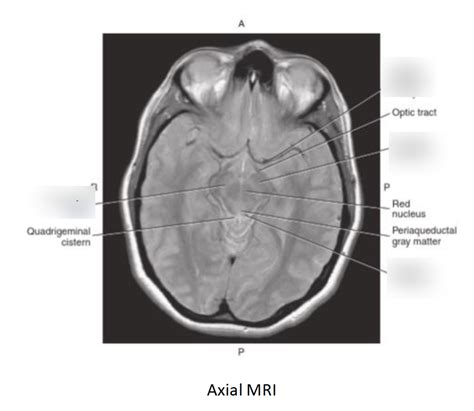 Axial MRI Substantia nigra Diagram | Quizlet