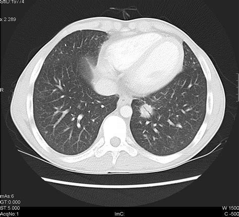 Tomografía computada del tórax, ventana pulmonar | Tórax, Torax