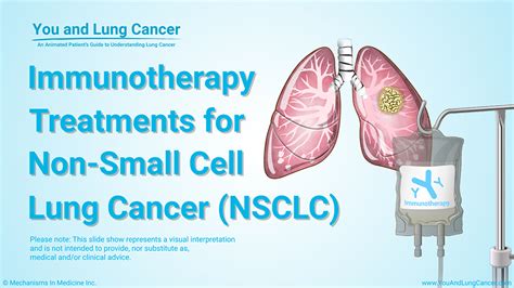 Slide Show - Immunotherapy Treatments for Non-small Cell Lung Cancer (NSCLC)