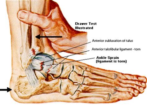 Ankle Ortho Exam 2 Flashcards | Quizlet