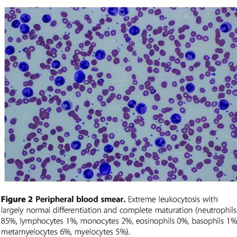 Peripheral blood smear. Extreme leukocytosis with largely normal... | Download Scientific Diagram