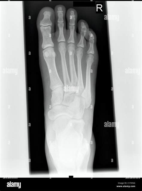 Right foot bones hi-res stock photography and images - Alamy