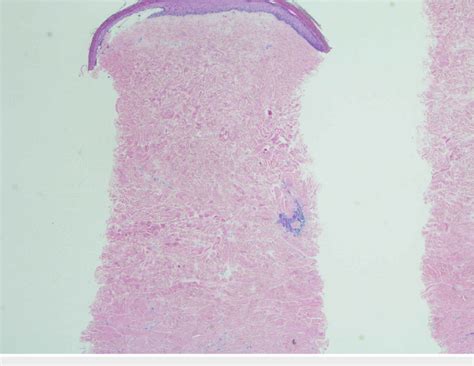 The dermis is expanded by increased, dense fibrosis (H&E, 20× ...