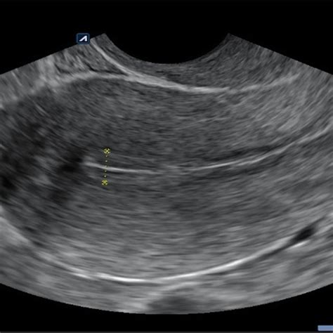 Ultrasound examination showing endometrial thickness in preparation for ...