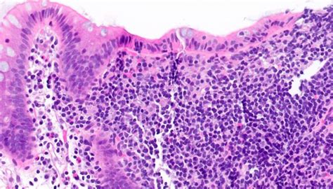 Pathology Outlines - Lymphocytic colitis