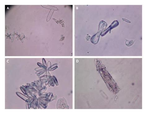 Urinary Calcium Oxalate Crystals in Ethylene Glycol Intoxication | NEJM