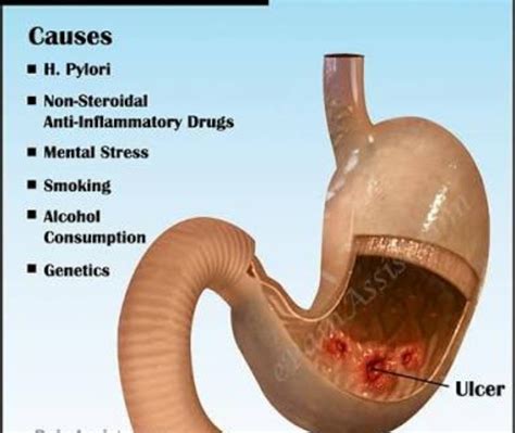 What Is Ulcer Symptoms - Ideas of Europedias