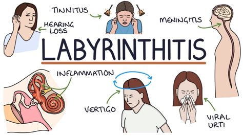 Labyrinthitis - Symptoms, Causes & Treatment - Santripty