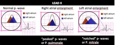 EKG – 4 – Atrial Enlargement – EMHUM