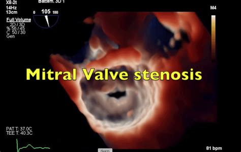 Mitral Valve Stenosis: 3D TrueVue - Echovision