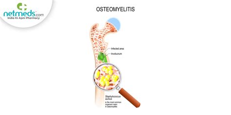 Osteomyelitis: Symptoms, Causes, Diagnosis And Treatment