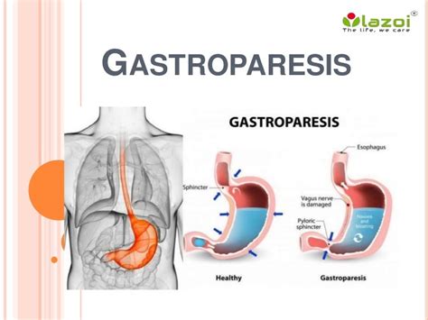 Gastroparesis: Causes, Symptoms, Diagnosis and Treatment