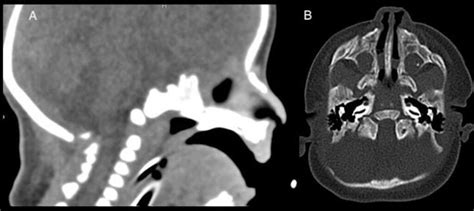 Congenital bilateral choanal atresia: an endoscopic approach with multi ...