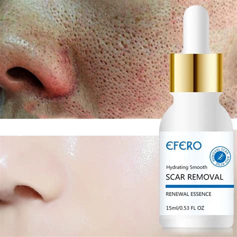 EFERO Shrink Pores Treatment Essence Face Serum Nose Blackhead Remover Acne Treatment Face Serum ...