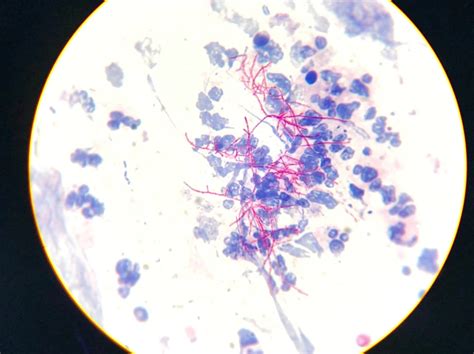 Acid Fast Stain - Principle, Reagents, Procedure, and Results