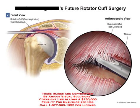 AMICUS Illustration of amicus,surgery,rotator,cuff,tear,supraspinatus,debrided,shaver,humerus ...