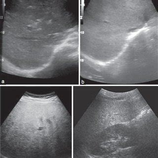 Shear wave elastography. Sonoelastography image (a) shows normal liver ...