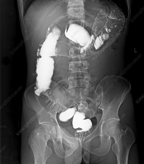 Reverse intestinal malrotation and colon malrotation, X-ray - Stock ...