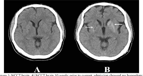 [PDF] Basal ganglia hyperdensity on computerised tomography of brain: a rare finding of non ...