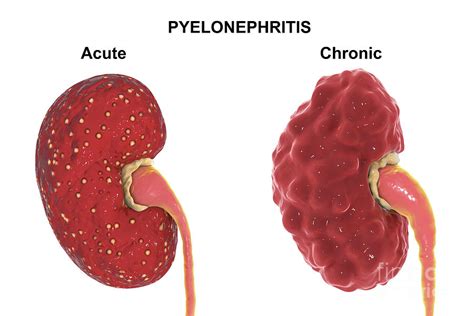 Acute Pyelonephritis