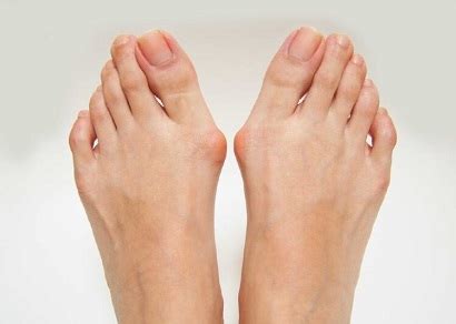 Bunion Symptoms & Prevalence - Foot Pain Explored