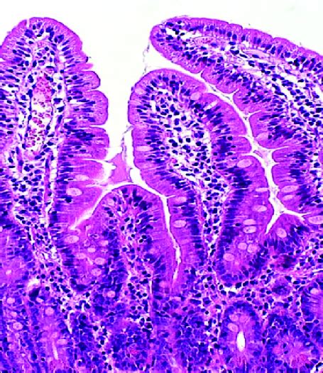 Intraepithelial lymphocytes without villous atrophy in biopsy taken... | Download Scientific Diagram