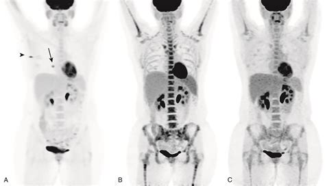 The Breast Cancer Survivor: Breast Cancer Metastasis To Spine