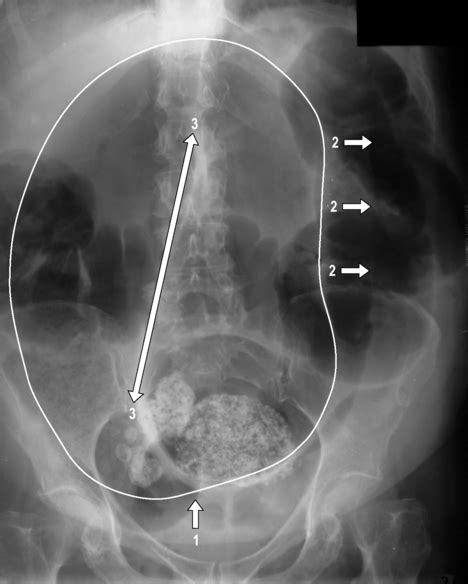 anatomy of sigmoid colon