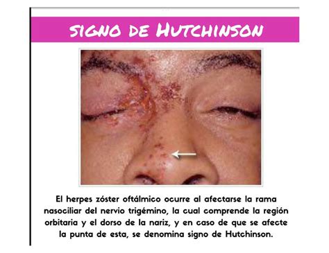 Resúmenes de Síndrome de Hutchinson | Descarga apuntes de Síndrome de ...