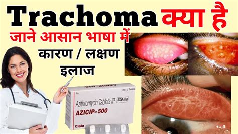 Trachoma | Trachoma Causes,symptoms,treatment | Trachoma in hindi - YouTube