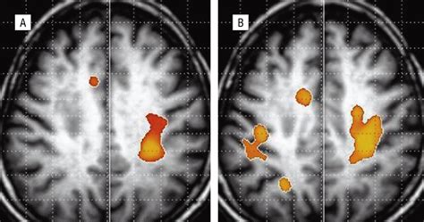 Ipsilateral Hemiparesis Caused by a Corona Radiata Infarct After a Previous Stroke on the ...